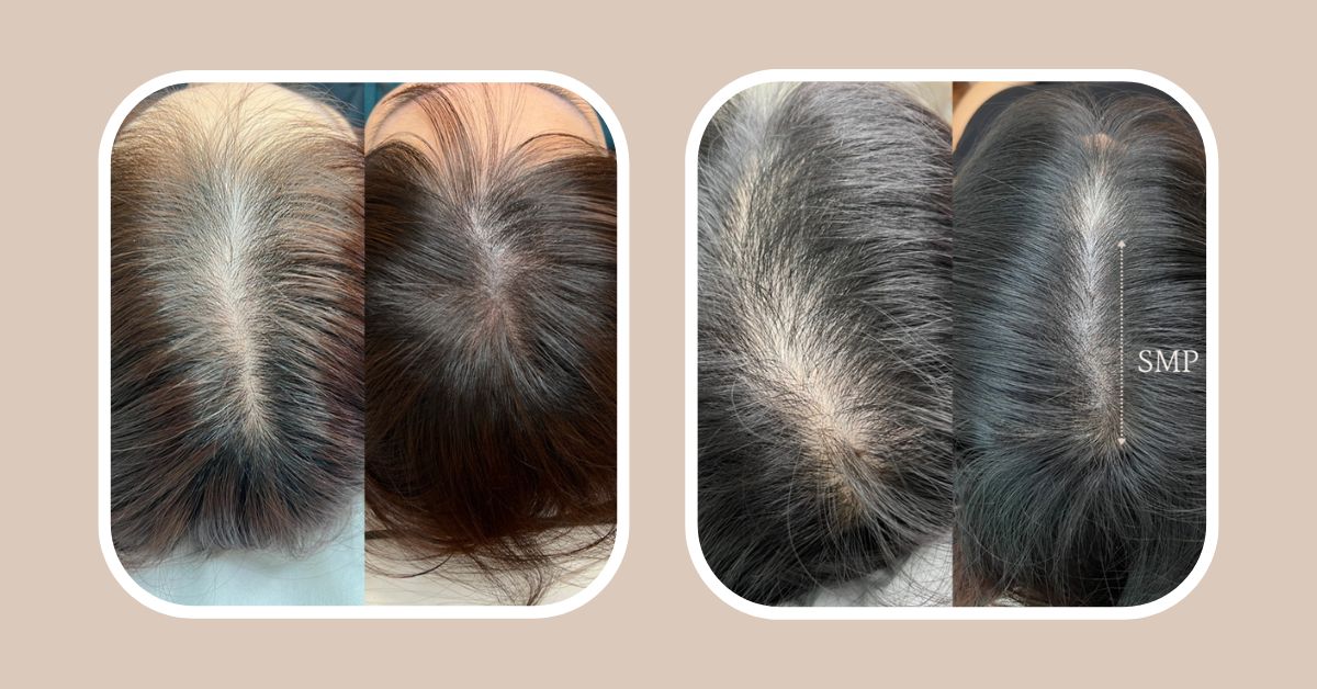 The Process of Scalp Micropigmentation